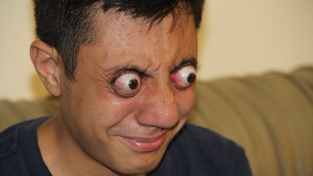 吓到了!小伙眼球竟然能外翻12毫米 欲挑战世界纪录