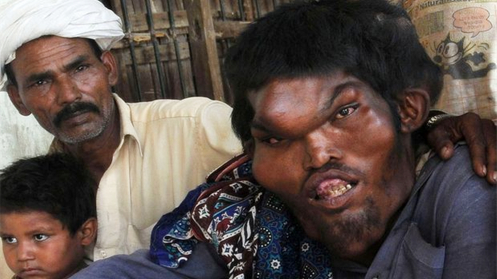 狰狞的兽脸!巴基斯坦男子遭遇骨骼畸变